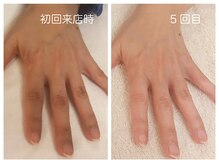 キレイテ 福岡天神店/50代/5回目【天神ハンドケア】