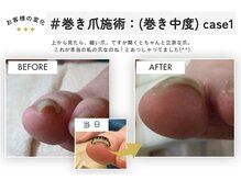 テネシー/＃巻き爪施術：(巻き中度) case1