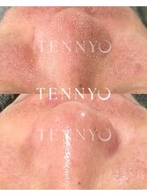 ルーナ 恵比寿(Luna)/TENNYOセラム付き毛穴洗浄