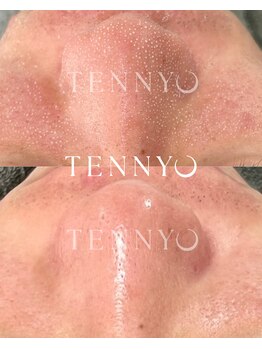 ルーナ 恵比寿(Luna)/TENNYOセラム付き毛穴洗浄