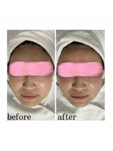 エクスクラメーションマーク(!!!)/超音波リフトアップ