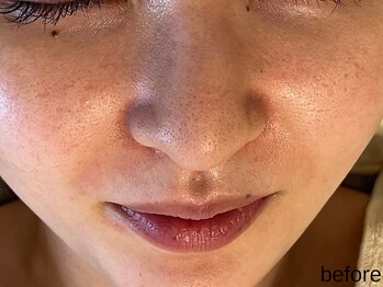 サロン ド エメ(salon de aimer)/【Before】赤み、くすみに