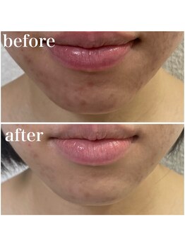 ビ ボーテ(美 Beaute)/REVI ハーブピーリング