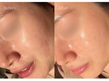 シューラディアント(ShuRadiant)/エンビロン/レチノール導入