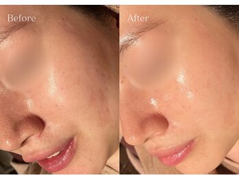 シューラディアント(ShuRadiant)/エンビロン/レチノール導入