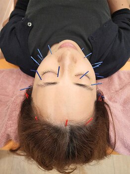 生駒サン整骨院の写真/ 【圧倒的な小顔効果】エステより変化を実感！女性鍼灸師による本格美容鍼でワントーン明るい理想の肌へ。