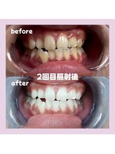 パレ 大阪十三店(Palet)/before/after