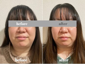 福多整体院/経絡美顔術2回目の効果