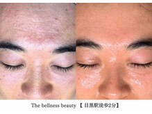 ザ ベルネス(The bellness)/【セルマン】肌改善・ピーリング