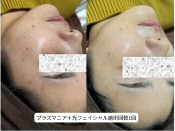 サロン アンネ(Anne)/プラズマニア＆光フェイシャル