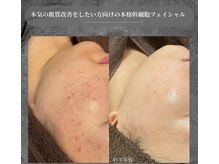 【ヒト幹細胞ケア】本格肌質改善でノーファンデ肌へ