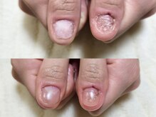 グラシナ なんば店/深爪/自爪育成/フィルイン