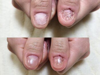 グラシナ なんば店/深爪/自爪育成/フィルイン