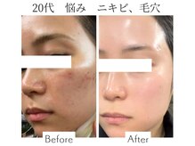 ファニービー 吹田店/20代 ニキビ 3ヶ月で改善
