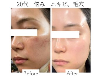 ファニービー 吹田店/20代 ニキビ 3ヶ月で改善