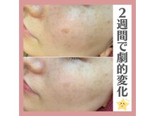 美人/プラズマシミケア