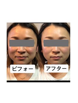 ナギ鍼灸院(nagi鍼灸院)/美容鍼1回のビフォーアフター