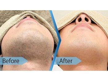 リジュベ(Rejuve)/大人気美肌脱毛/メンズ/船橋男性