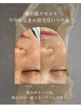 ヒュウ(hue.)/韓国発最新肌管理[セルマン]