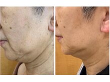 アンパス(Unpas)/オールハンド小顔の効果