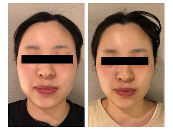 ベルージュ(Belrouge)/小顔フェイスライン