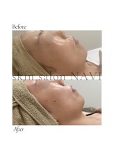 ナビ(NAVI)/【最新小顔】韓国ピーチリフト