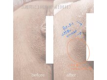 アール(ar.)/おまたエステ/フェムケア（1回）