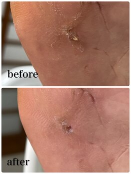 爪屋/痛い魚の目その2