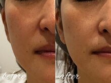 アモリール(Amolir)/40代　ほうれい線　頬コケ改善　