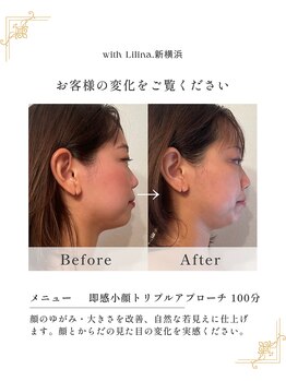 ウィズリリナ 新横浜(with Lilina.)/横顔美人になる眠れる小顔ケア