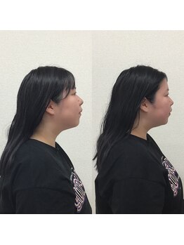 オズ六本木/六本木小顔矯正(造顔)姿勢整う