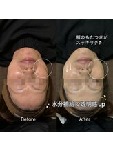 ミヨン(Miyong)/たるみ改善/水分爆弾