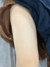 ムーンストーン(Moonstone)/メンズひざ上脱毛3回目です