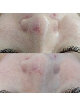 ヴェルシック(Belchic)/鎮静効果も期待できる磁気パック