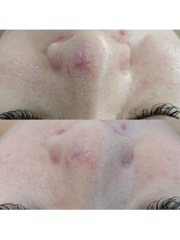 ヴェルシック(Belchic)/鎮静効果も期待できる磁気パック