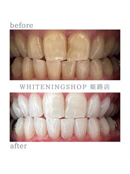 ホワイトニングショップ 姫路店/ホワイトニング