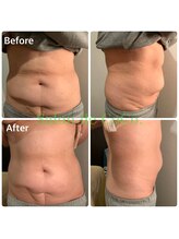 サロンドココ(Salon de CoCo.)/美腸ケアコース前後