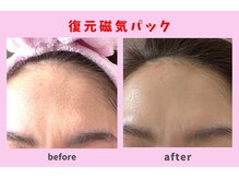 磁気パック1回の施術です。皆様の効果はブログをご覧下さい。