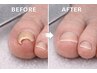 【お試し価格】巻き爪ケア1本お試し ¥10000→¥5000