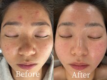 スウィート リリー(Sweet Lily)の雰囲気（肌管理コース×WiQo水光ピーリング　Before After）