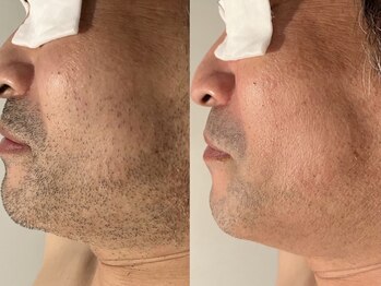 バタフライ 津田沼店(Butterfly)/顔脱毛