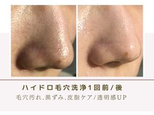 ルナビューティー 赤坂(LUNA beauty)/ ハイドロフェイシャル効果実感!