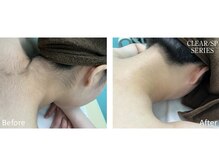メン脱 三軒茶屋(Men脱)/【ビフォーアフター】うなじ脱毛