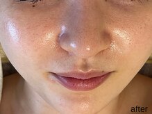 サロン ド エメ(salon de aimer)/【After】透明感！発光肌