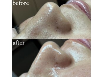 クリアビューティー(CLEAR BEAUTY)/ハイドラフェイシャル