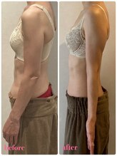 リール 新宿店(RIRE)/50代後半　バストアップ症例