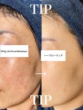 ニコサロン(nico salon)/しみケア/くすみ/艶肌