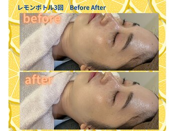 ピュアスキンサロン 恵比寿店(pure skin salon)/レモンボトル