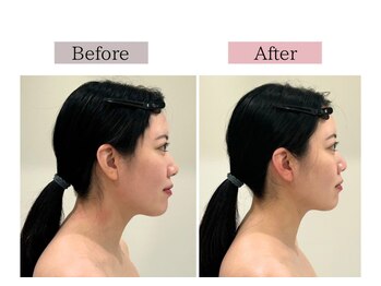 フロリール アザブジュウバン(FlorirAzabujuban)/食い縛り/左右差/二重顎に◎