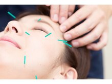 めいてる/美容鍼/リフトアップが得意です